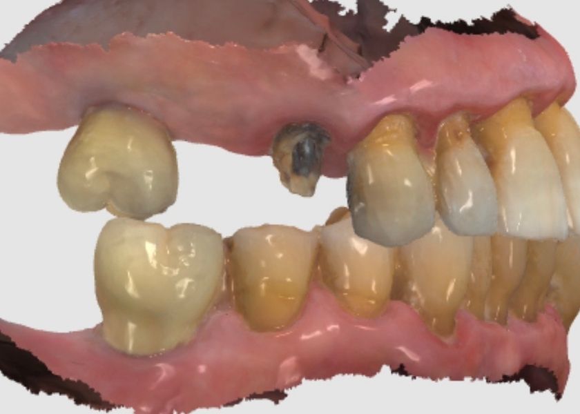 Preguntas frecuentes sobre implantes con poco hueso en Atocha